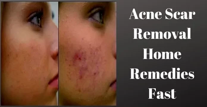 Quick Home Remedies for Acne Scar Removal